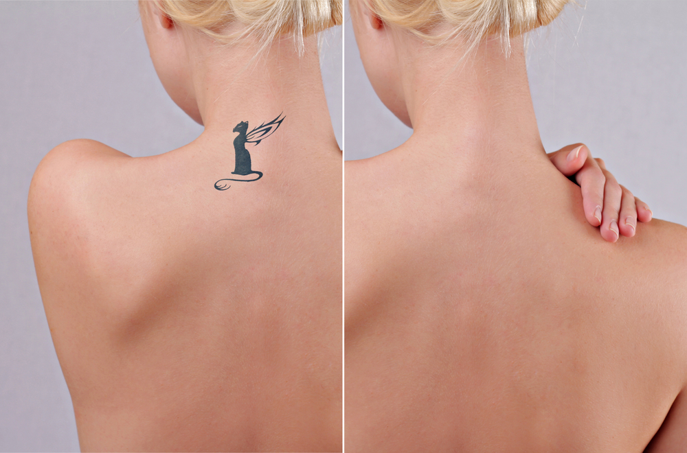 Tattoo Removal - Dr Lipy Gupta